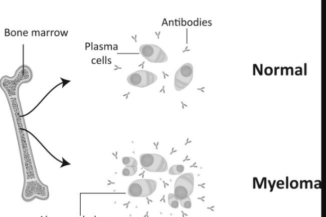 6 Types of Therapy that Can Be Done to Treat Multiple Myeloma Sufferers