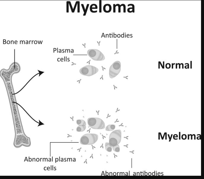 6 Types of Therapy that Can Be Done to Treat Multiple Myeloma Sufferers