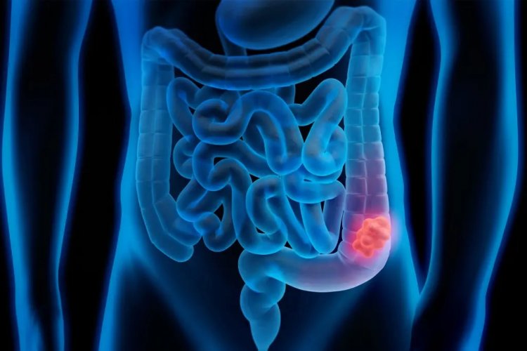 These 5 concerning symptoms may indicate colon cancer